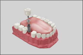 Dental Implants Dentist Carstairs Dental Alberta