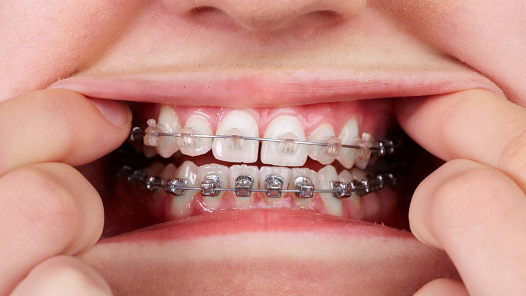 Orthodontic Care at Carstairs Dental
