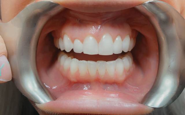 Post-treatment Smile Reveal - Carstairs Dental