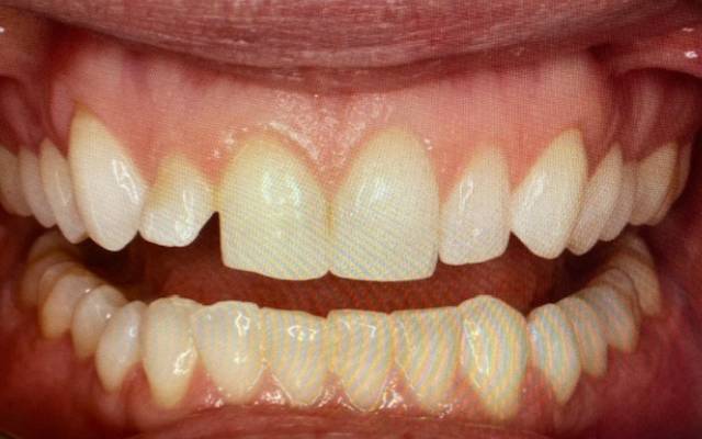 Before Post-treatment Smile Reveal - Carstairs Dental