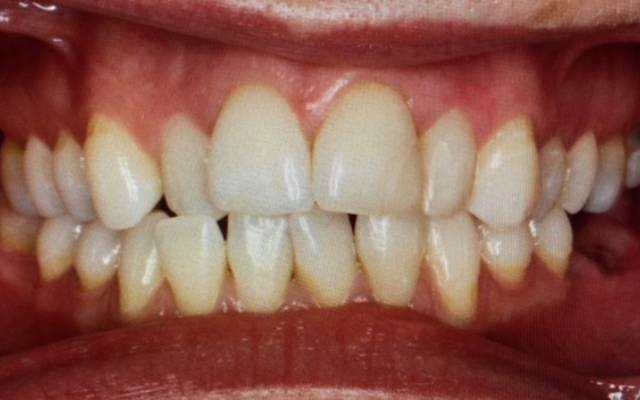 Before there with Orthodontics & Teeth Whitening Treatment - Carstairs Dental