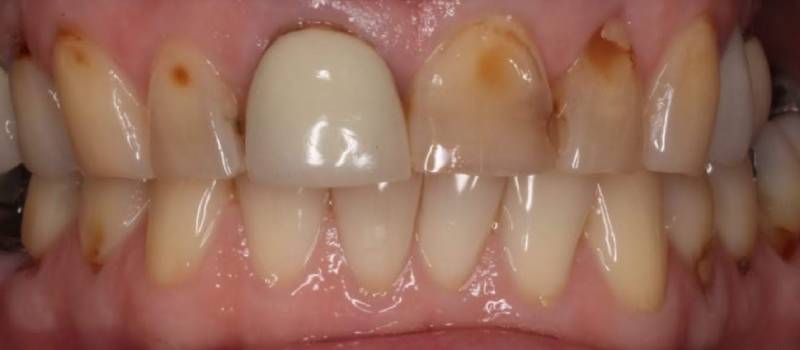 Smile Reveal #4 A classic example of smile improvement with Veneers - Carstairs Dental