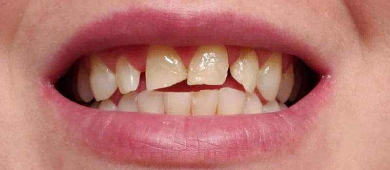 Before: A perfect smile reveal involving Dental Buildups and Crowns - Carstairs Dental
