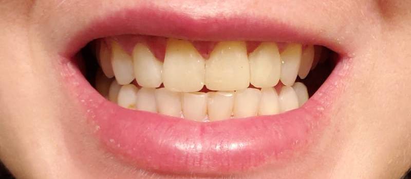After: A perfect smile reveal involving Dental Buildups and Crowns - Carstairs Dental