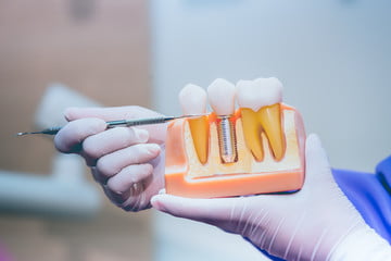 dental implants dentist carstairs