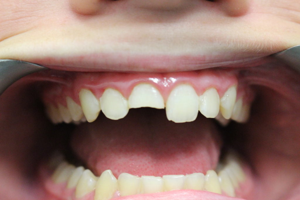 broken tooth in Carstairs Dental Alberta