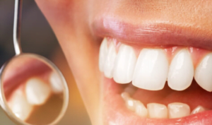 teeth whitening carstairs