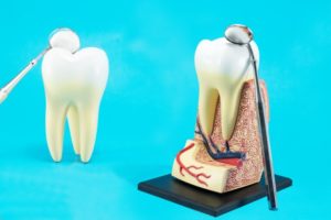 dry socket prevention tips