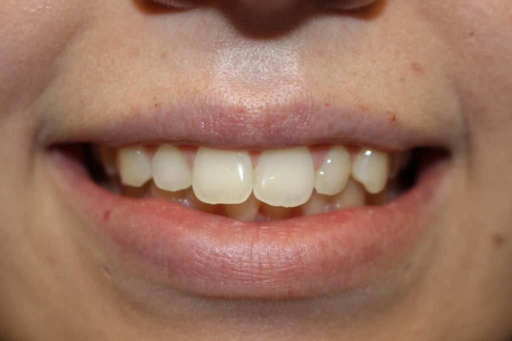 dental crown carstairs Dental Alberta