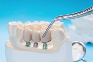 carstairs dentist dental bridges
