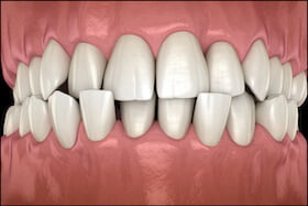 Crossbite Issues Dentist Carstairs Dental Alberta