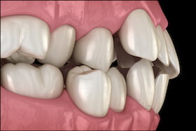 Crowded Teeth Dentist Carstairs Dental Alberta