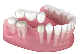 Dental Bridges Dentist Carstairs Dental Alberta