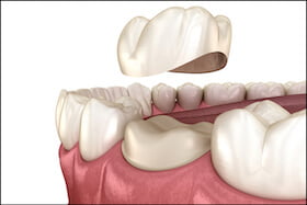 dental crowns dentist in carstairs