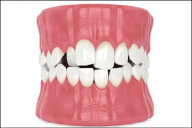 Misaligned Jaw Dentist Carstairs Dental Alberta