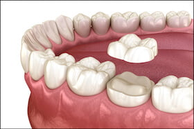 Porcelain Inlays Onlays Dentist Carstairs Dental Alberta