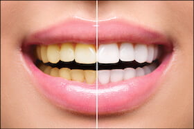 teeth whitening Dentist Carstairs Dental Alberta