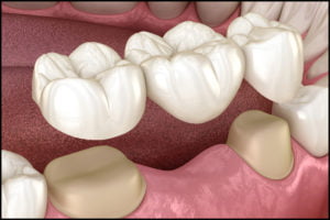 Dental Bridges dentist in carstairs ab