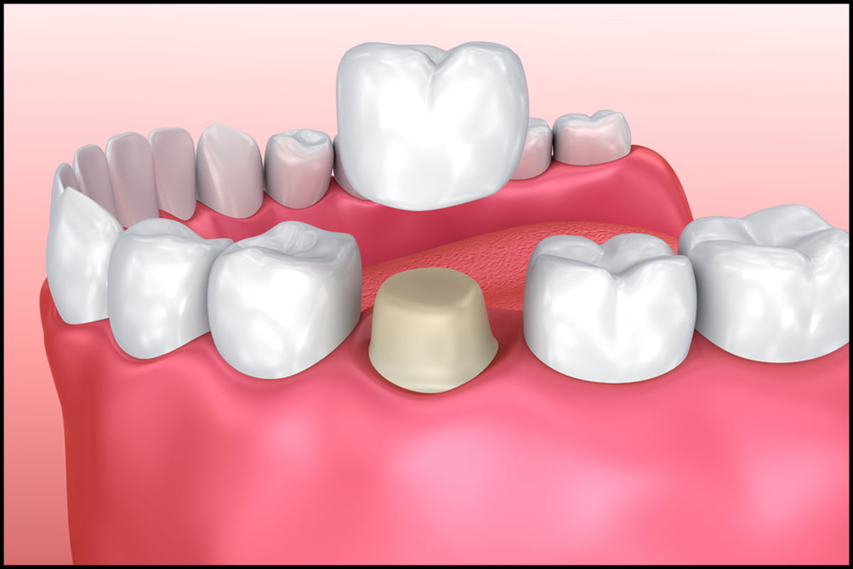 Dental Crowns dentist in carstairs ab