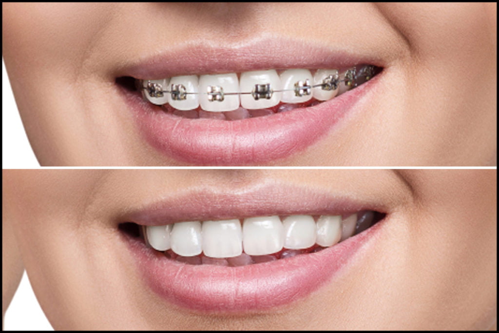 Orthodontics Braces Before / After​