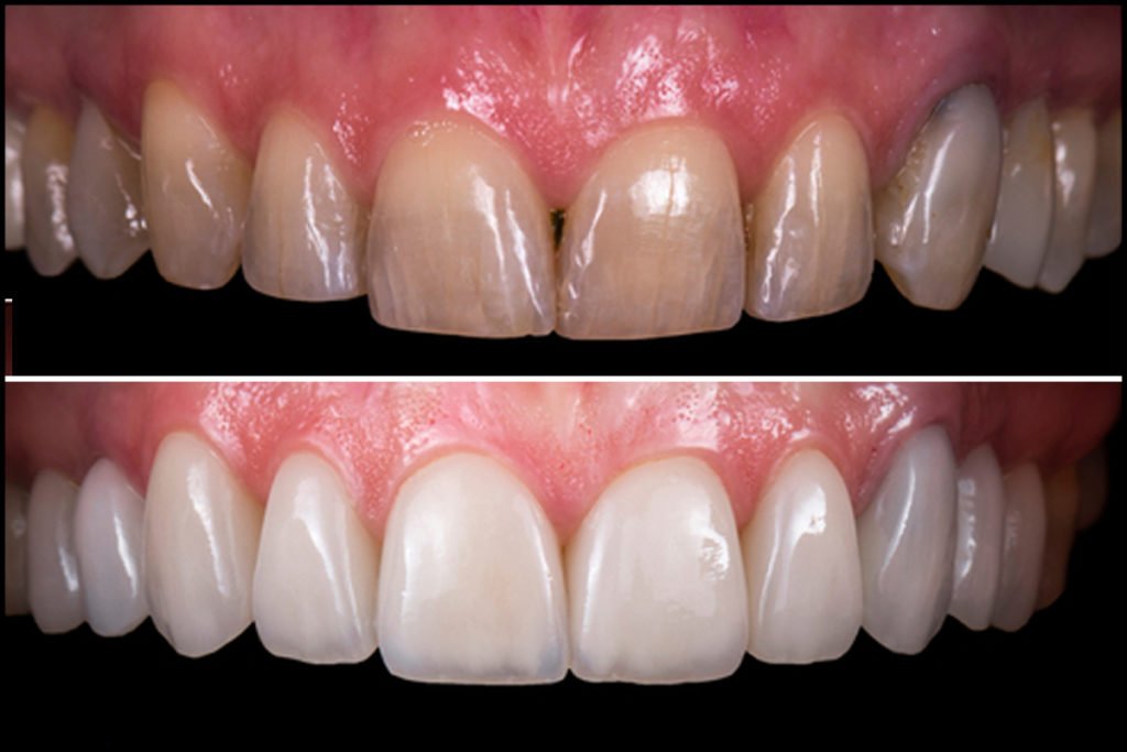 dental veneers before after
