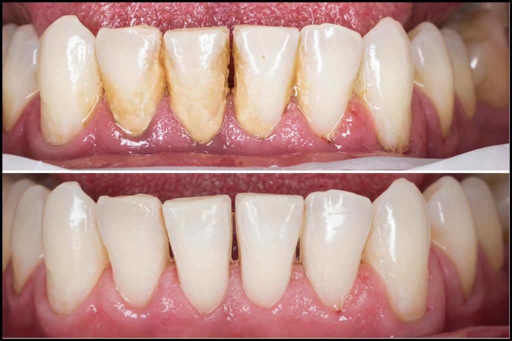 dental cleaning before after