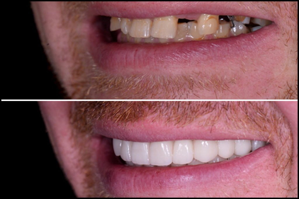 dental implants before after