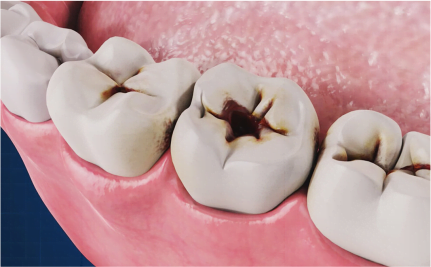 pediatric dentistry Dental decay