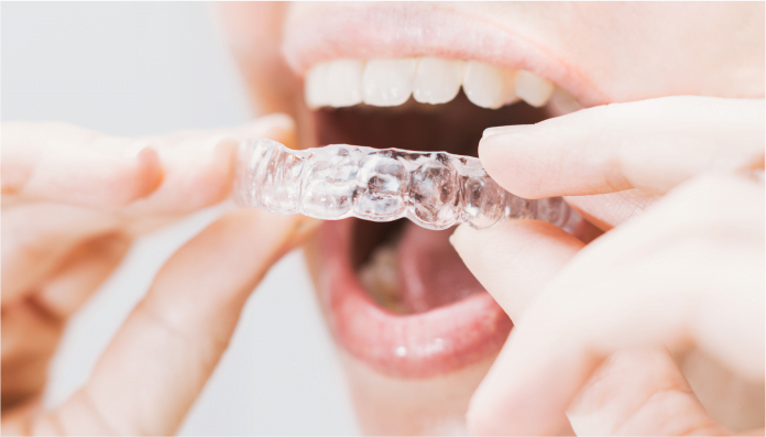 Invisalign Simpler Alignment