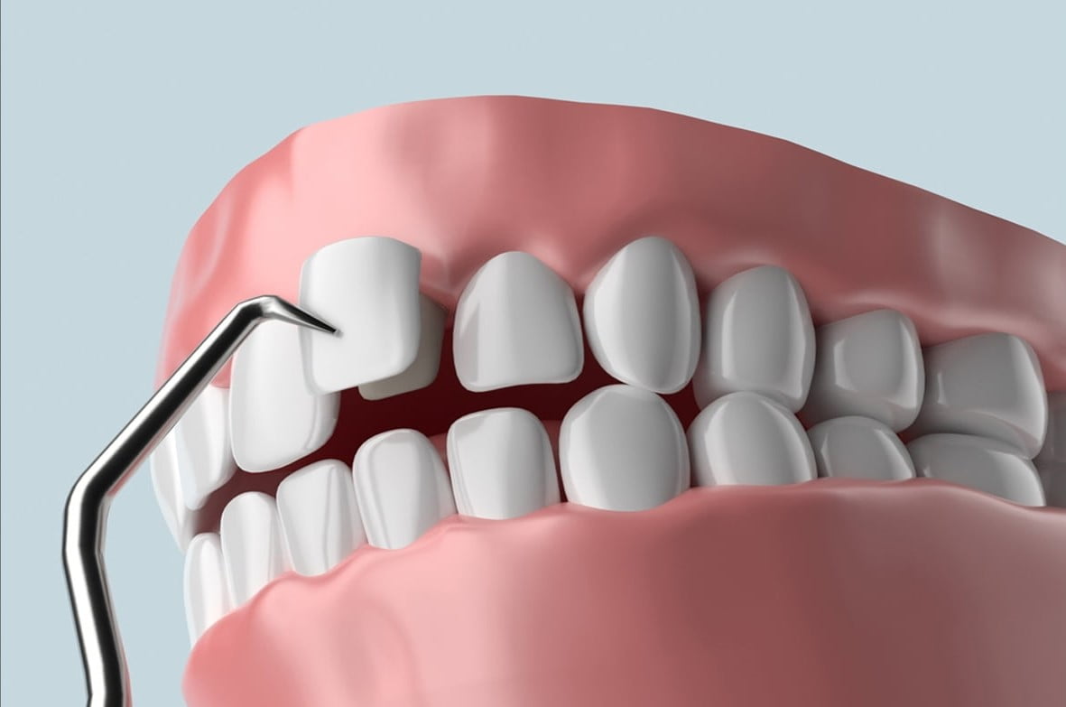 Dental Veneers