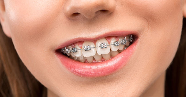 Orthodontic-Braces