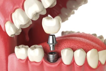 Pediatric Dentistry Tooth Restorations
